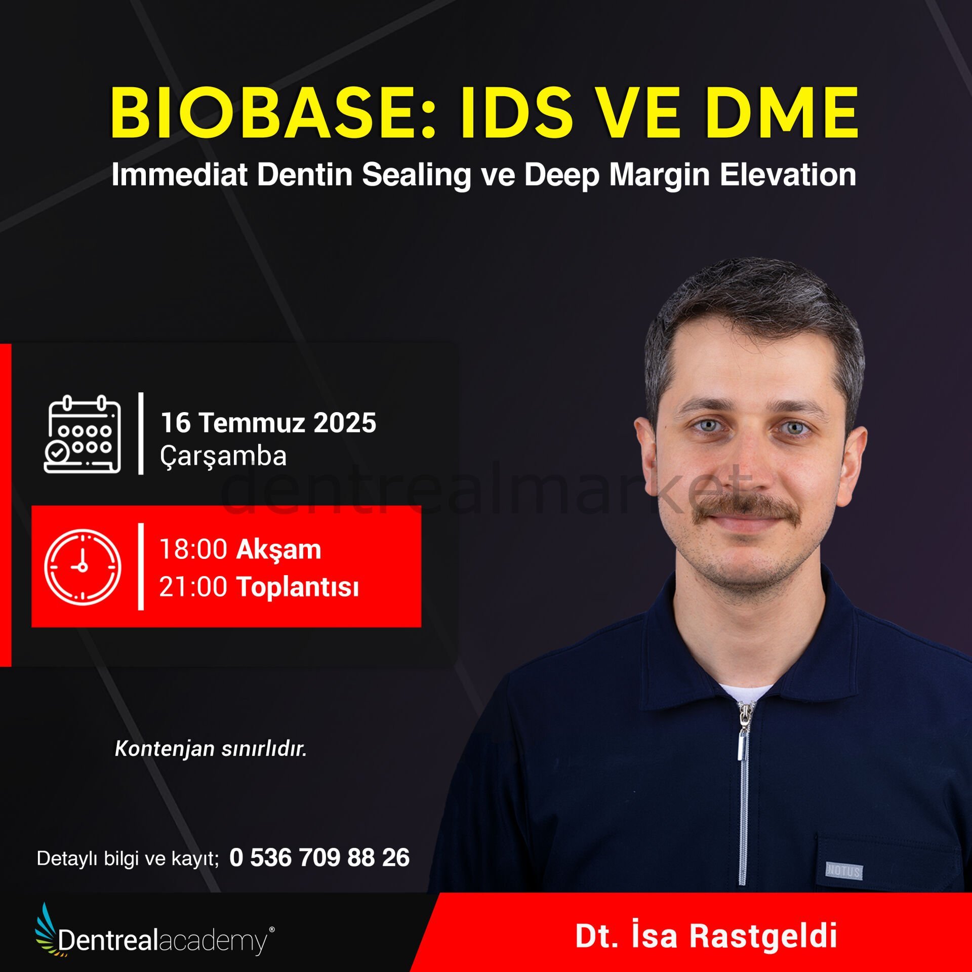 Biobase: IDS ve DME - Immediat Dentin Sealing ve Deep Margin Elevation - Dt. İsa Rastgeldi
