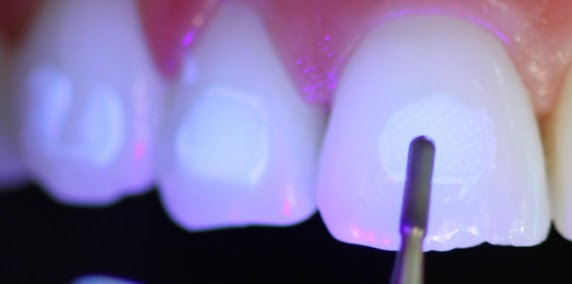 orthodonti braket sişman temizleme frezi