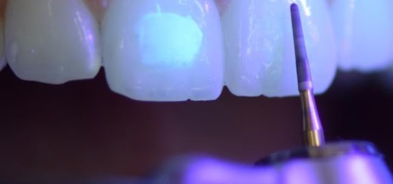 frank dental braket temizleme orthodonti frezi