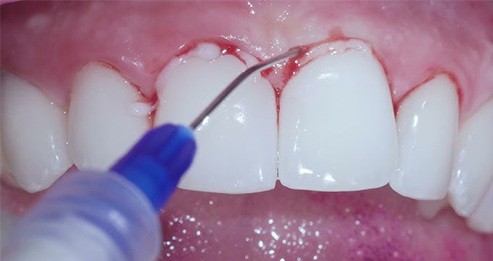 ChloSite Kloreksidin Jel