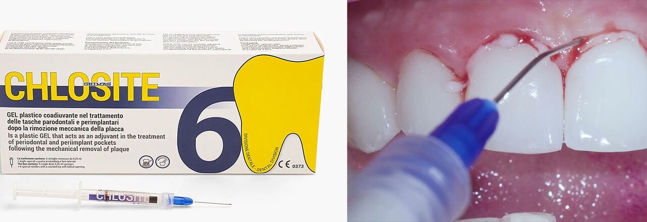 Chlosite Periodontal Hastalıklar için Antiseptik Jel