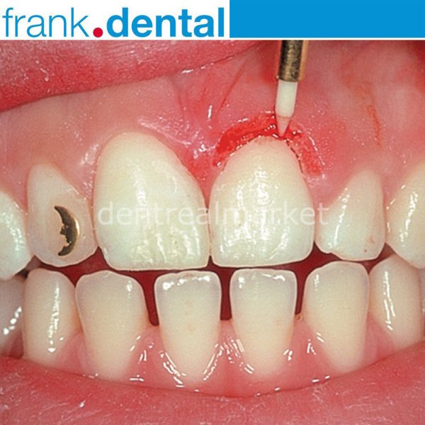 Gingiva Trimmer Yumuşak Doku Frezi - STT249