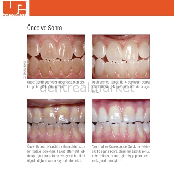 Opalescence Quick PF 45% Refill - Ofis Tipi Beyazlatma 20'li