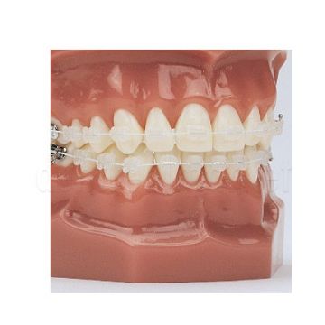 Brilliant Niti Coated Cosmetic Tel