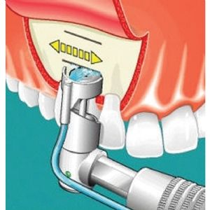 Cerrahi Testere 2444 Mikro Cerrahi Anguldurva Set