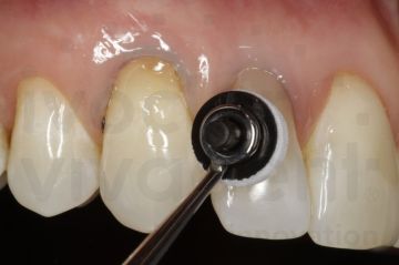 OptraSculpt Pad Assorti – Yapışmaz Kompozit Modelleme Aleti