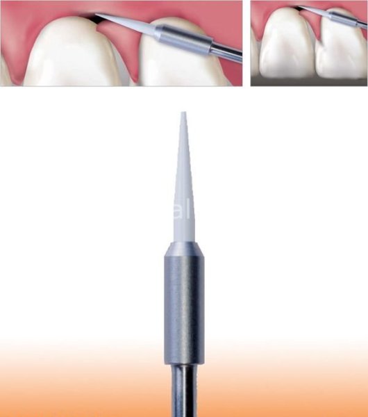 Gingiva Trimmer Yumuşak Doku Frezi