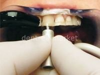 Cervical Former Matris Yedeği