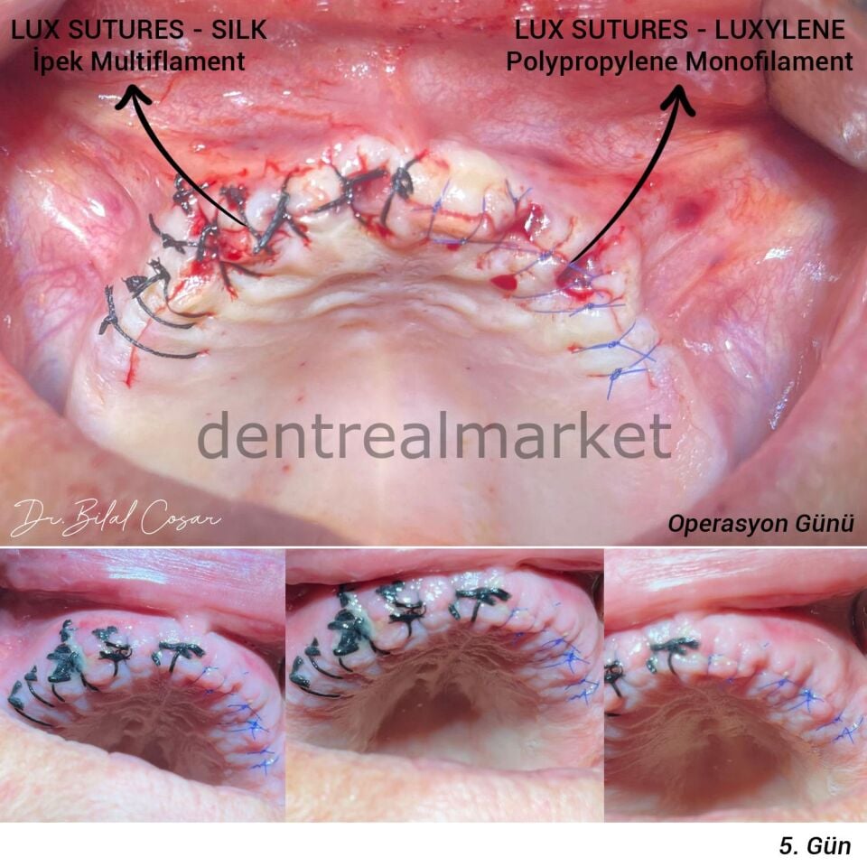 Luxylene Polipropilen Monoflament Cerrahi Sutur - Ters Keskin