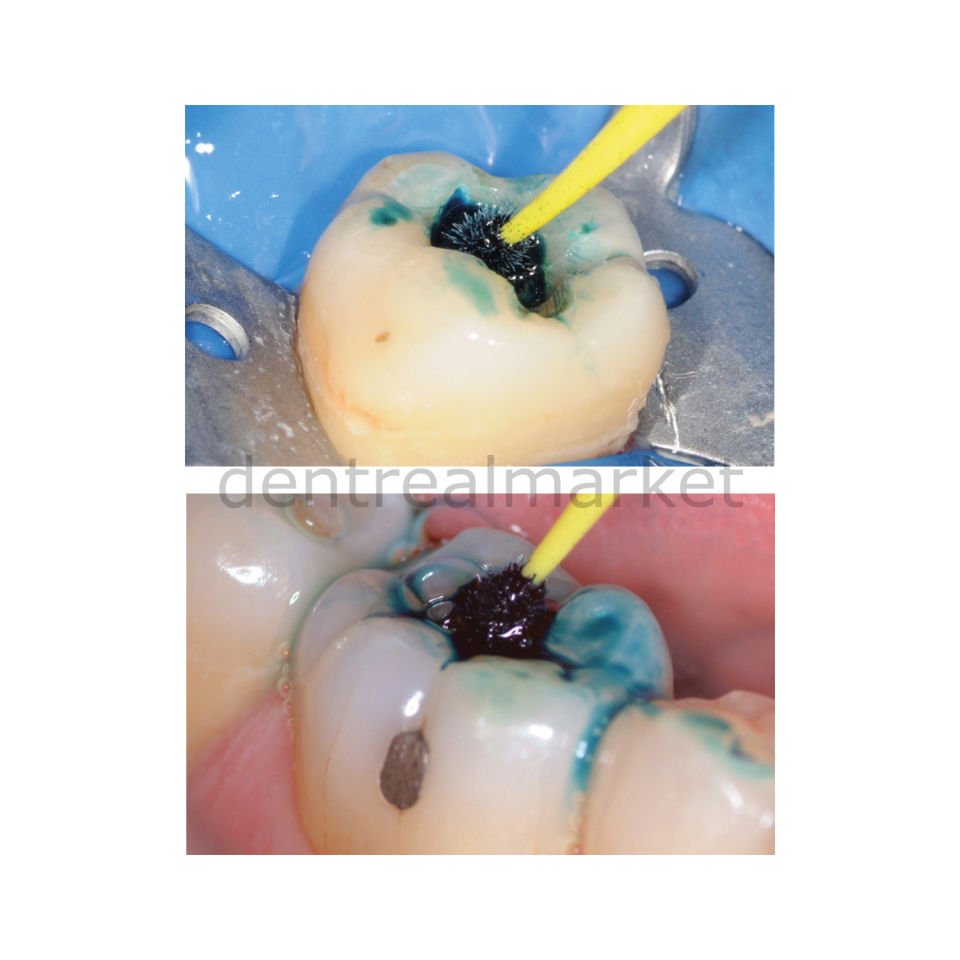 Expose Tek Kullanımlık Çürük Belirleyici Extra Fine 1.0 mm