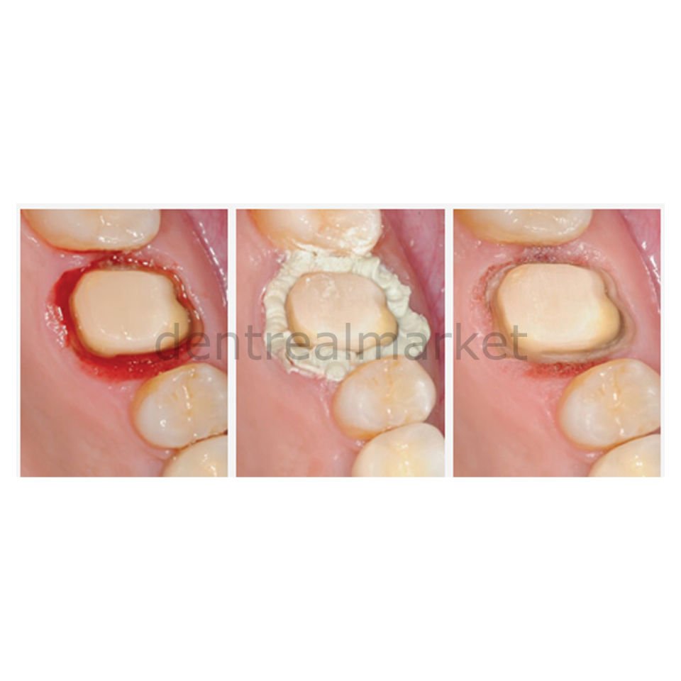 Access Edge Yüksek Viskozite Diş Eti Kanama Durdurucu