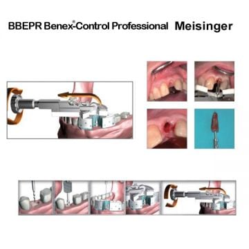 Benex Control Basic - Kök Çıkarma Sistemi