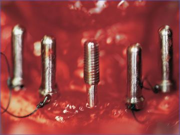 Paralel İmplant Dril Guide