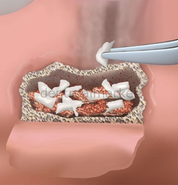 Parasorb Fleece Genta HD Antibiyotikli Collagen Sünger - Antibiyotikli Membran SKT: 2024/12