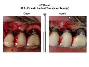 Nitibrush Peri-İmplantitis Frez Seti - 4 Adet