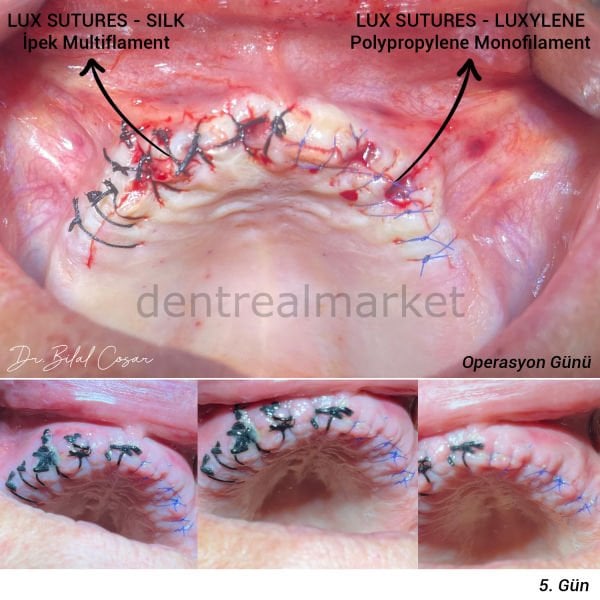 Luxylene Polipropilen Monoflament Cerrahi Sutur - Ters Keskin