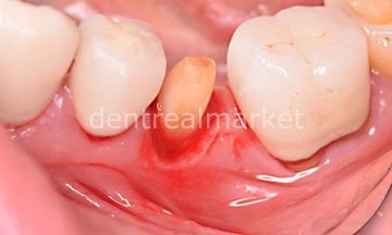Gingiva Gen Retraction Paste SKT:2023/10 ***