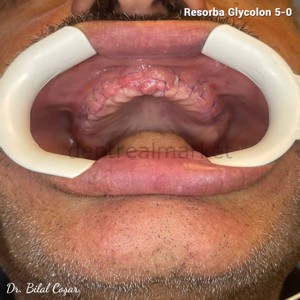 Glycolon Monofilament Absorbe Cerrahi Sutur  5-0 - 24'lü Kutu