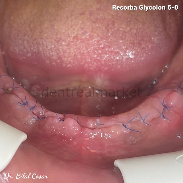 Glycolon Monofilament Absorbe Cerrahi Sutur  5-0 - 24'lü Kutu