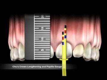 Chu's Crown Lengthening Gauge