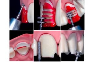 Perfect Tooth Preparation Kesim Seti