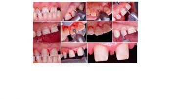 Perfect Tooth Preparation Kesim Seti