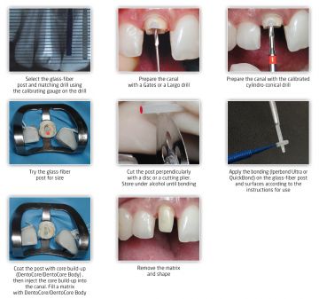 Dentoclic Cam Fiber Post Dril Refil