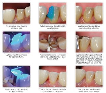 Reflectys Anterior and Posterior Refil - 4 gr