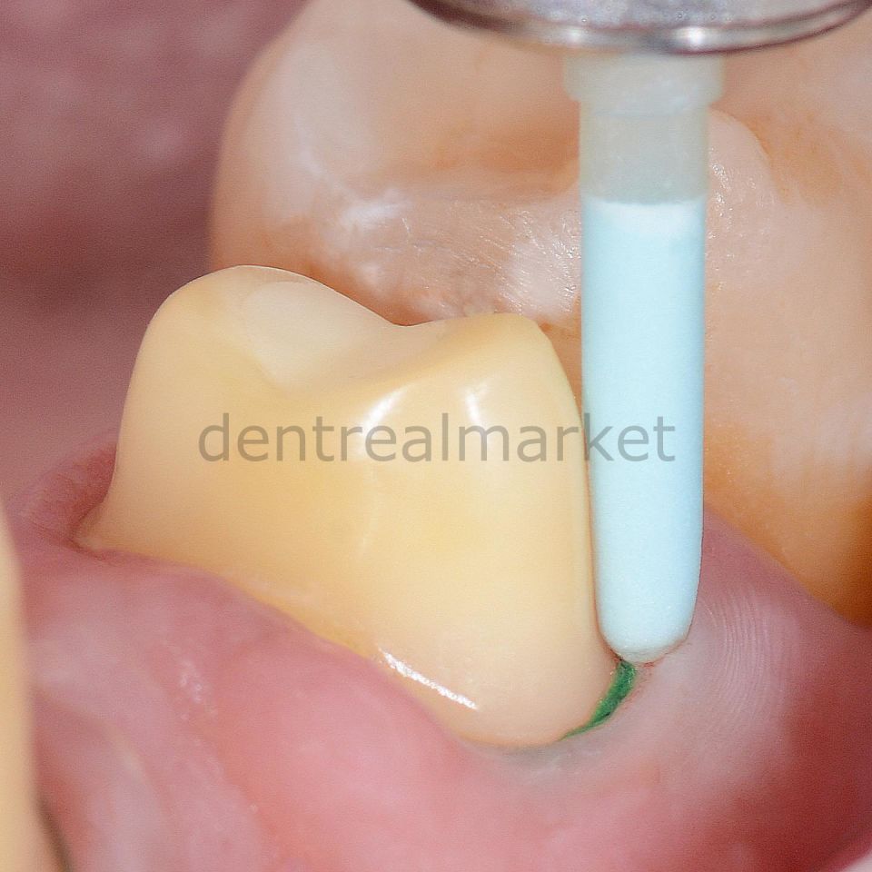 Opticlean Debonding ve Geçici Temizleme Frezi - 12 Adet