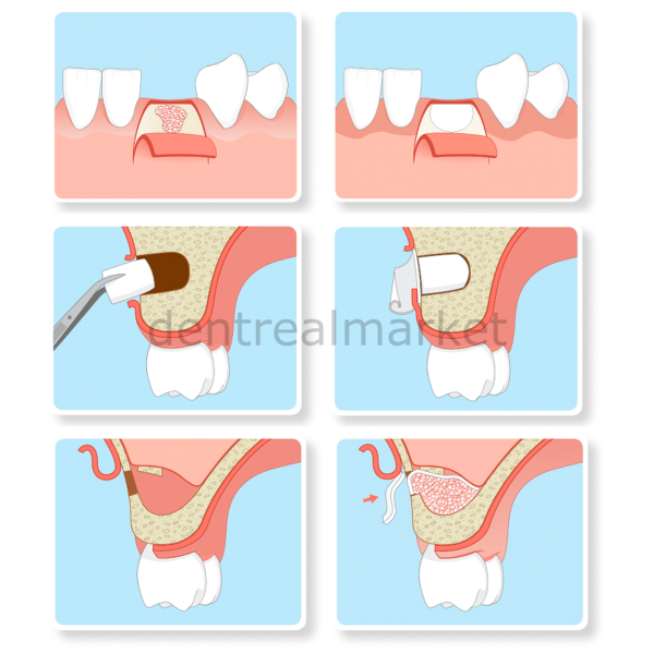 Parasorb Resodont Forte - Collagen Membran 25*22 mm - Kampanya ***
