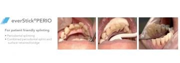 EverStick PERIO 1*8 cm - Fiber Takviyeli Periodontal Splintleme