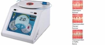 Softlase Pro Diode Lazer Cihazı