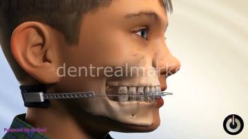 Eaglewear Cervical Pull Headgear Enselik
