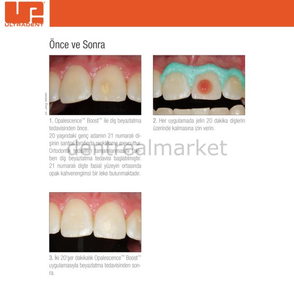 Opalescence BOOST PF %40 Beyazlatma 1 Hastalık Paket