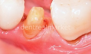 Gingiva Gen Retraction Paste -  Retraksiyon Pastası