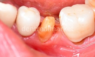 Gingiva Gen Retraction Paste -  Retraksiyon Pastası