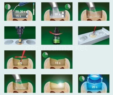 Gluma 2 Bond Refil