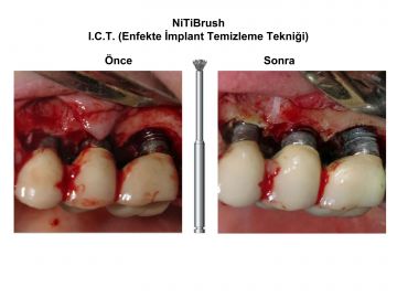 Nitibrush Peri-İmplantitis Frez Seti - 2 adet