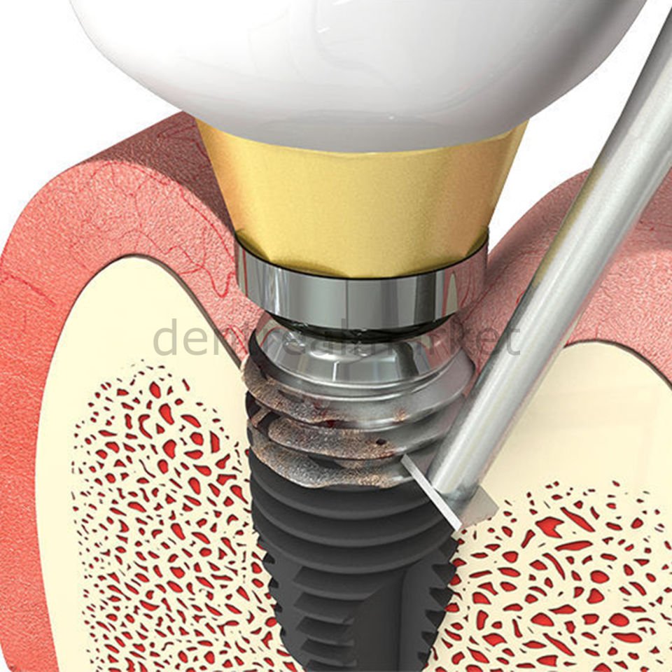 T-Brush Peri-İmplantitis Fırçası