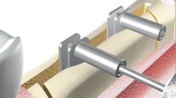 Crest Control Kemik Genişletme Bone Expander Kit