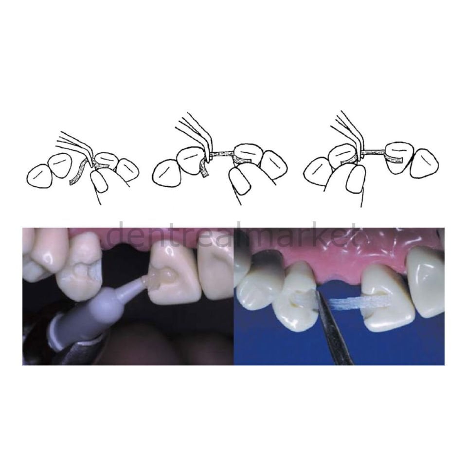 Ribbond Ultra Örgülü Cam Fiber Splint Refill 22 cm