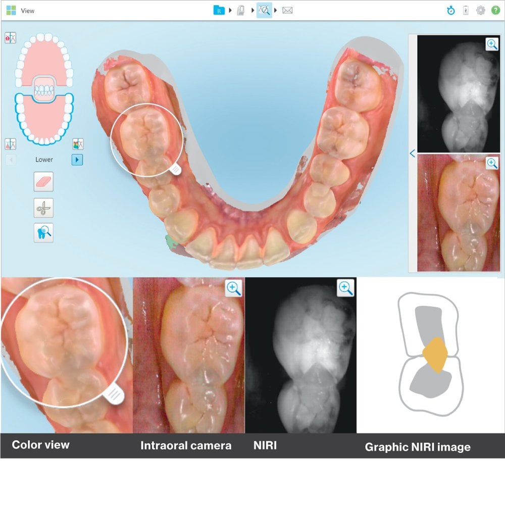 iTero Element 5D Ağız içi Tarayıcı Scanner